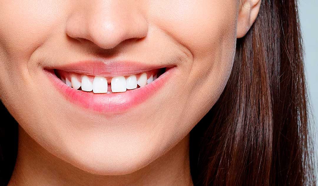 Răng thưa nên niềng răng hay bọc răng sứ?